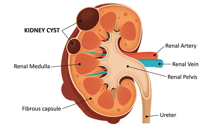 kidney-cysts