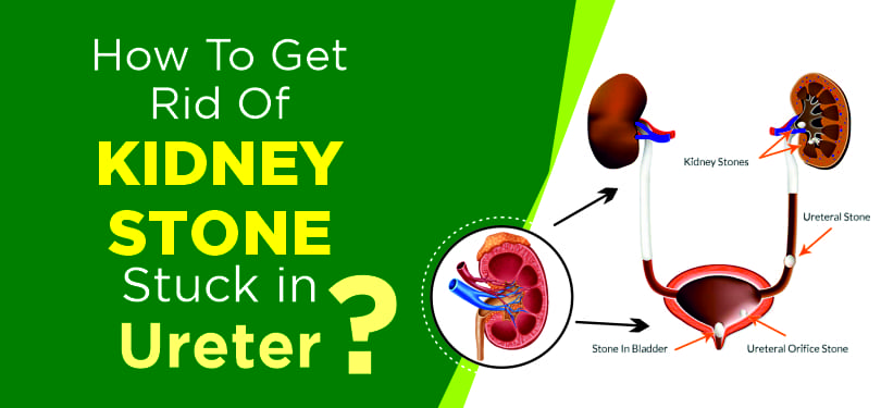 get rid of kidney stone stuck in ureter